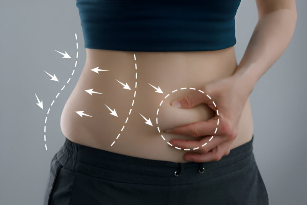 Tummy tuck in Dubai 3 Tummy Tuck Surgery In Dubai