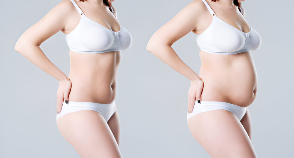 Tummy tuck in Dubai 1 Best Tummy Tuck Surgeon In Dubai