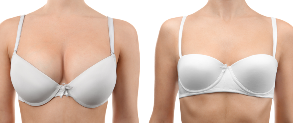 Breast reduction Dubai 3 Breast reduction before and after