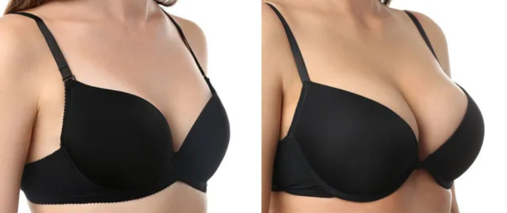 Breast reduction Dubai 4 Breast reduction before and after