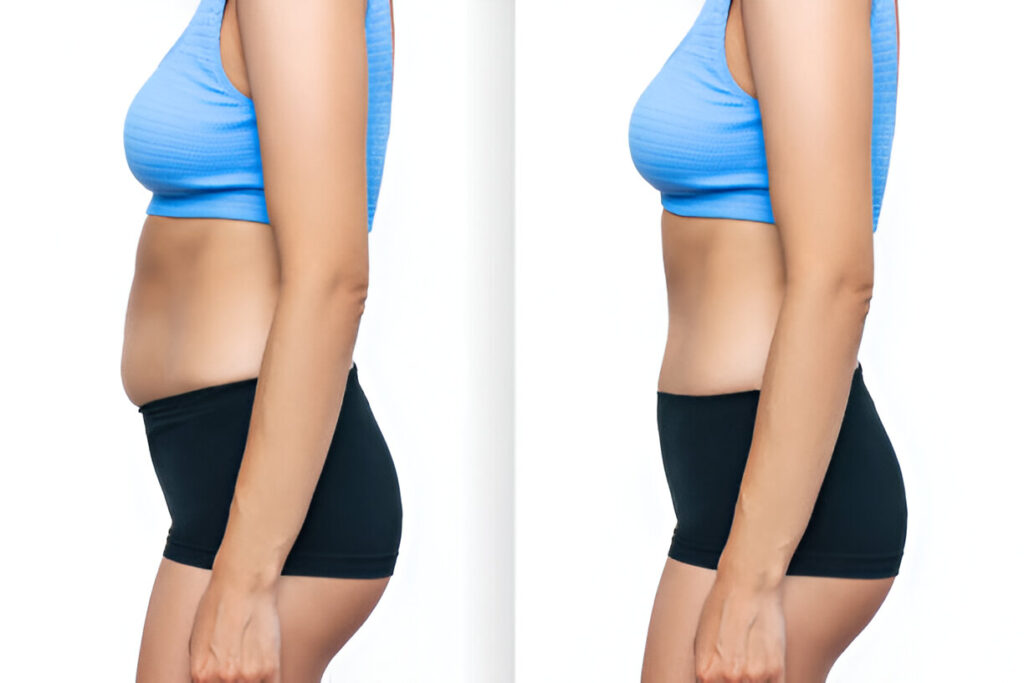 Tummy tuck in Dubai 5 Tummy tuck before and after images