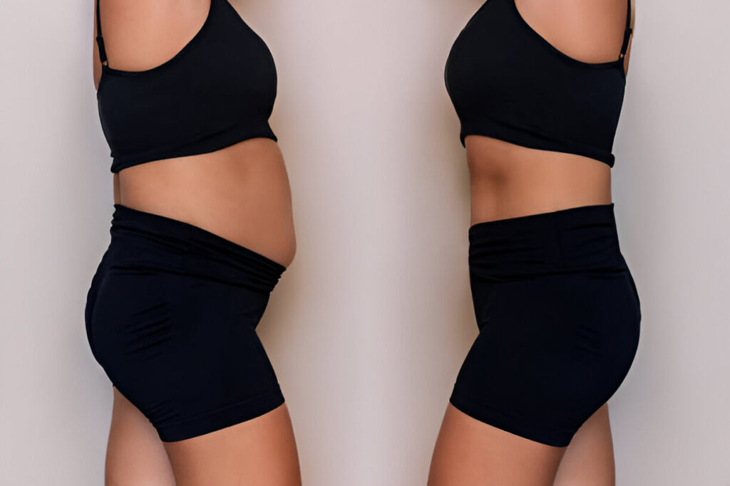 Tummy tuck in Dubai 4 Tummy tuck before and after