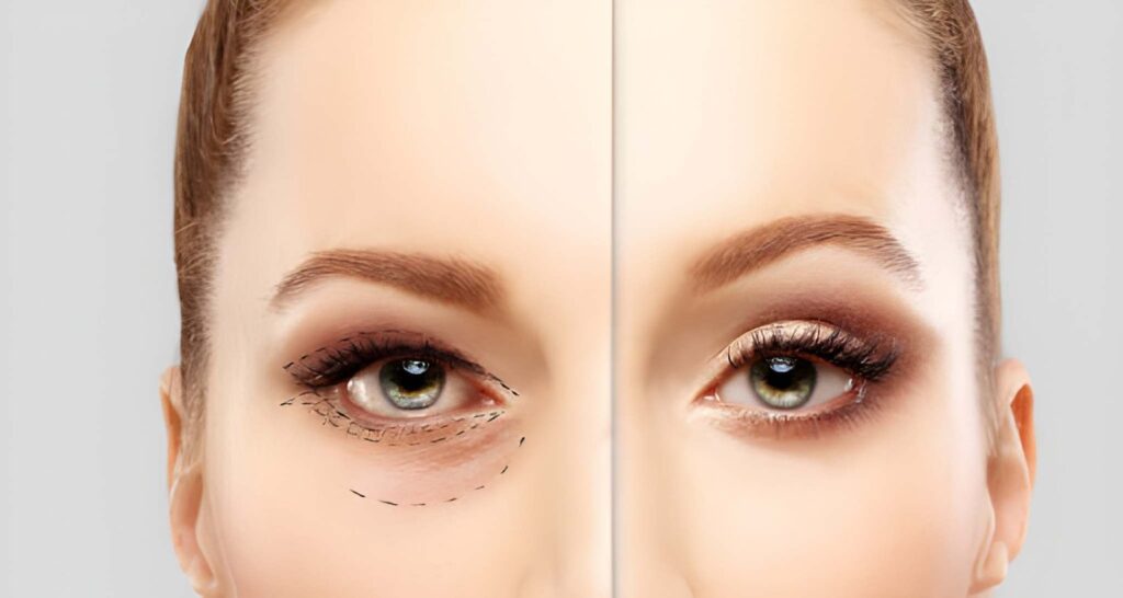 Upper Blepharoplasty Dubai