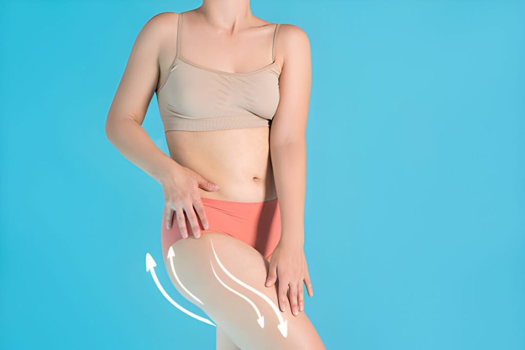 Thigh Lift Scars After 1 Year