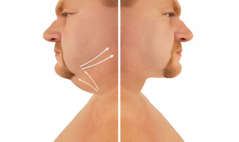 Everything About Botched Chin Liposuction